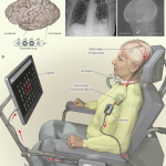ALS Communication Aids: Eye Control Glasses Transform Lives